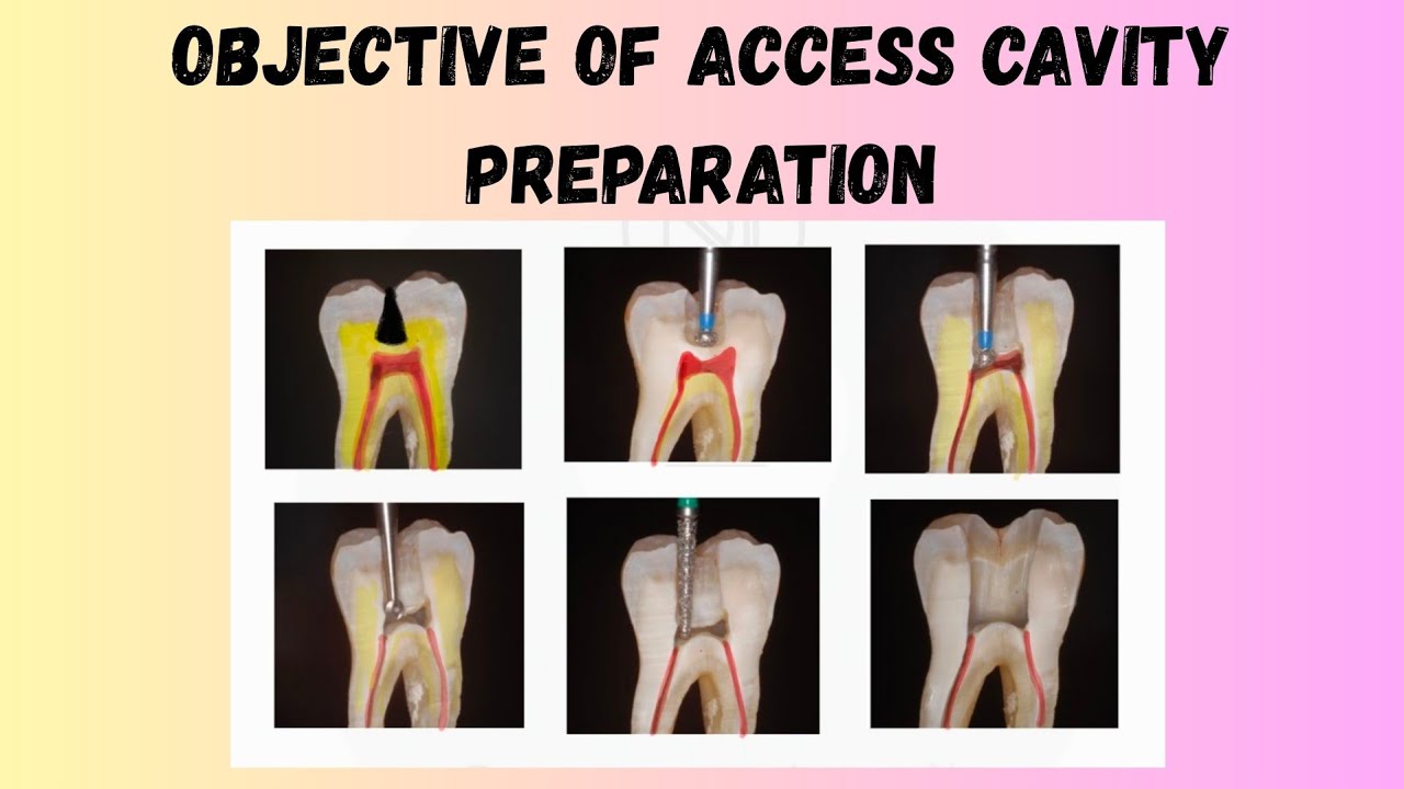 Objective of Access cavity preparation