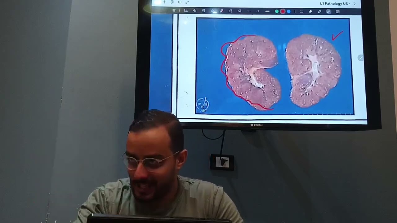 Renal - patho 3 - congenital anomalies of renal system 