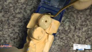 Разборная вкладка. Зуб 36(Переходите на наш сайт: Звоните нам: 8-800-700-25-25., 2016-04-09T13:22:55.000Z)