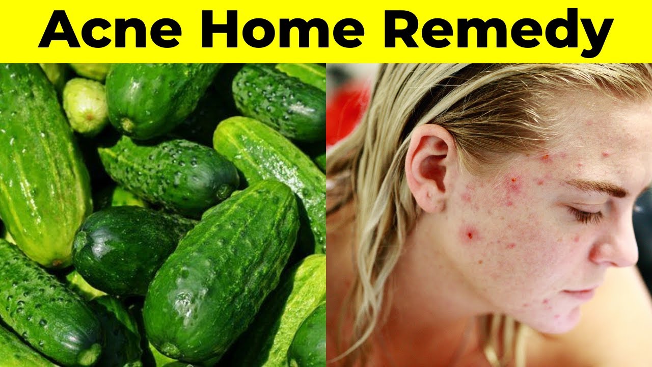 Getting Rid Of Acne The Cheap Way YouTube