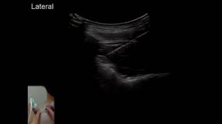 US-guided therapies for shoulder pain - Video S4 ID 169434