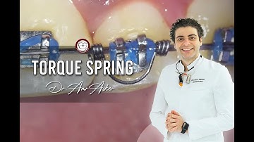 Orthodontic torque spring for negative torque Dr. Amr Asker