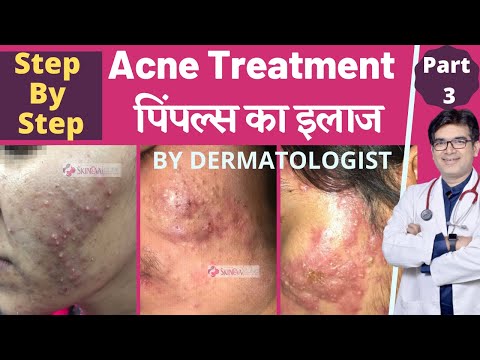 Acne Treatment By Dermatologist In Hindi | Pimples का इलाज | Acne Treatment Medicines | Dr Sunil