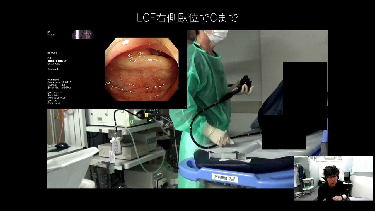 カール先生の大腸内視鏡挿入術ー実践編ー 後半戦その1 LCFの越え方