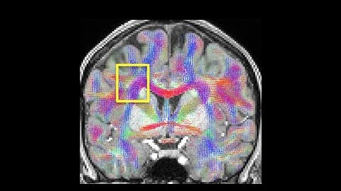 Share Your Science: Analyzing Human Brain Connections with GPUs