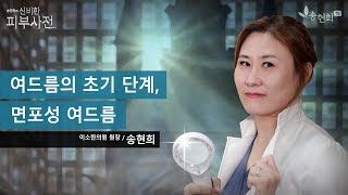 [신비한 피부사전] 여드름 바로 알기- 1탄, 좁쌀 여드름,화이트헤드, 블랙헤드 (면포)