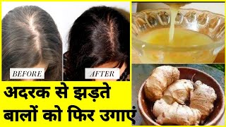 दोबारा से बालों को उगाए, झड़ने से रोके How to REGROW HAIR Naturally for Men & Women |Treat Baldness