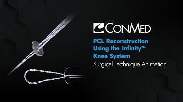 PCL Reconstruction Using the Infinity™ Knee System - CONMED Animation