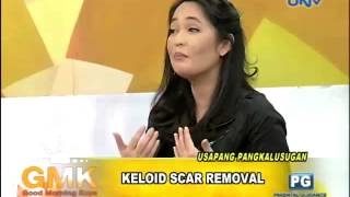 Keloid Scar Removal