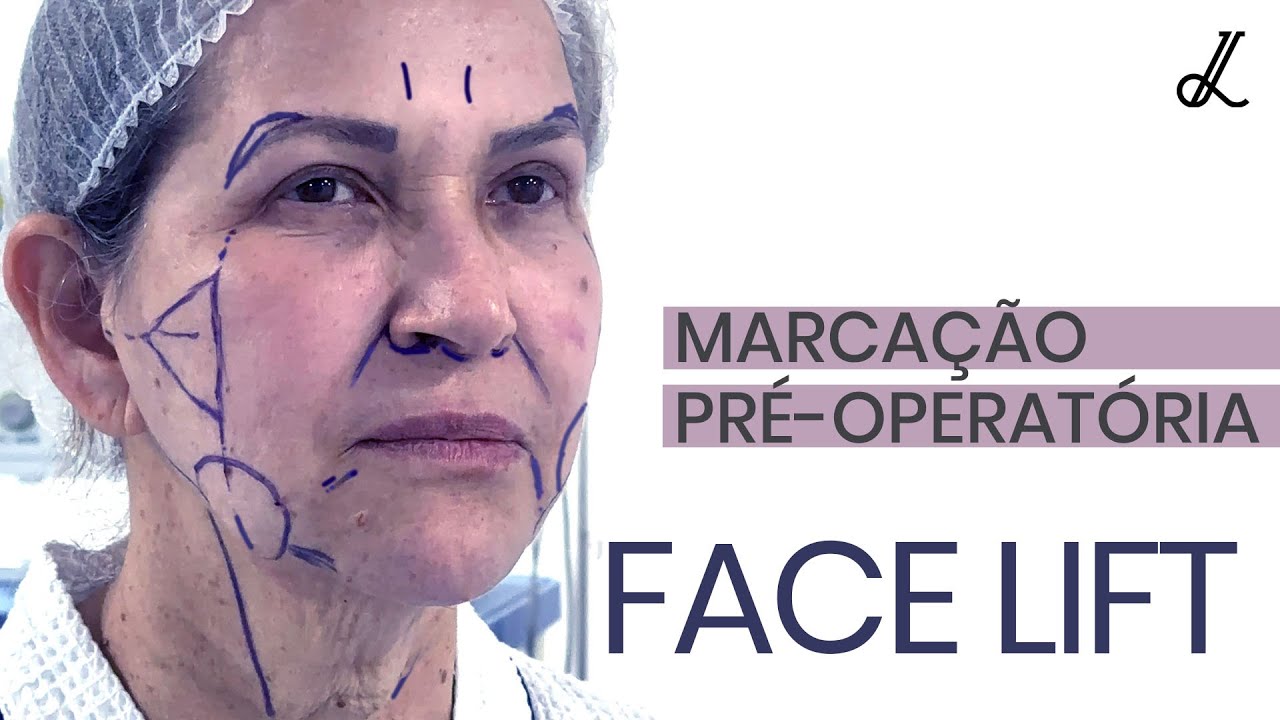 Facelift | Marcação Lifting de Face e Blefaroplastia