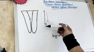 cleaning and shaping of root canal (step down technique)