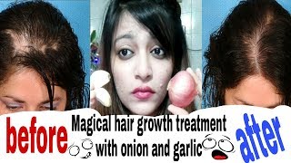 Magical Hair growth treatment with Onion and Garlic |hair growth solution |solution of baldness