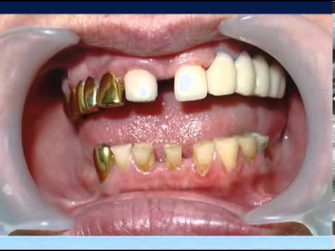 Протезирование зубов на имплантатах (Снежко В.В.)