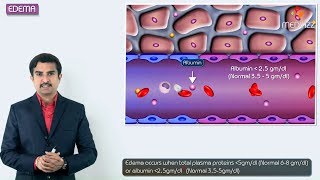 1.Edema introduction  Hemodynamic pathology Fmge, Neet PG and  usmle