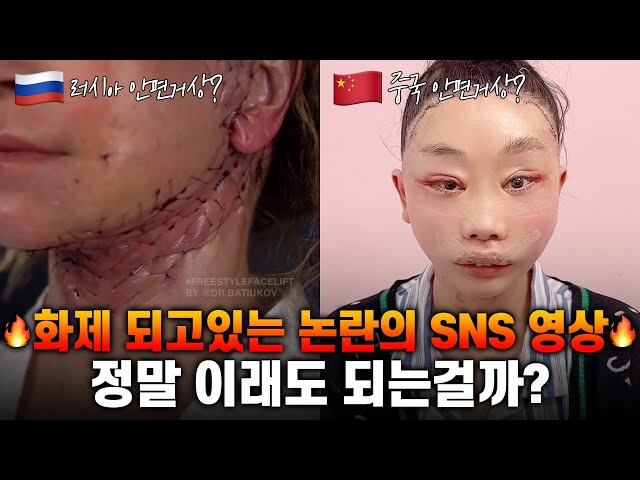 SNS 논란의 안면거상😱 진짜 왜 이래..?
