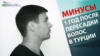 ПЕРЕСАДКА ВОЛОС В ТУРЦИИ 12 МЕСЯЦЕВ МИНУСЫ. Пересадка волос в Турции результат 2019. Minoxidil4you