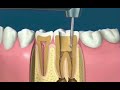 Les tapes de la devitalisation dentaire