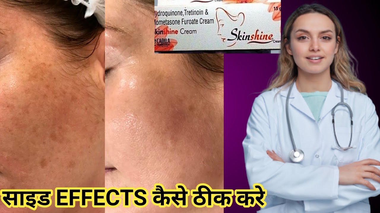 Steroid Cream Side Effects Treatment Skin Shine Cream Side Effects