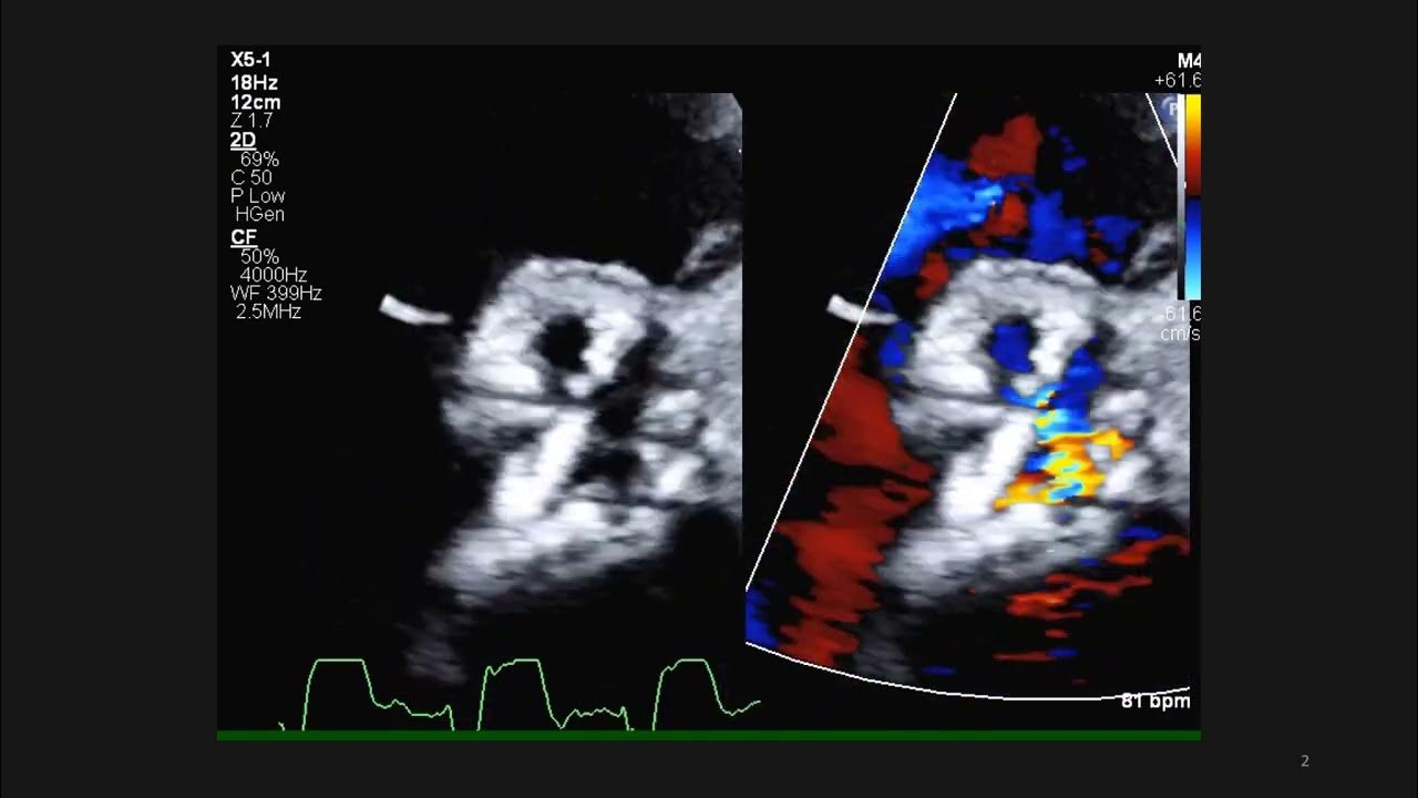 vsd-post-aortic-valve-replacement-youtube