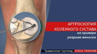 Артроскопия коленного сустава на примере разрыва мениска - инфографика операции на колене