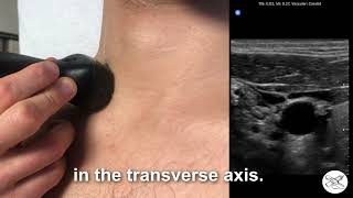 Identifying the Jugular Vein with POCUS