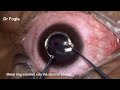 Femtosecond laser assisted stromal segment implantation for corneal ectasia