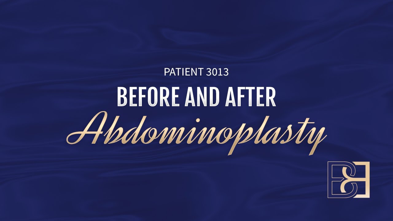 Full Abdominoplasty with Liposuction {Patient 3013} Before & After
