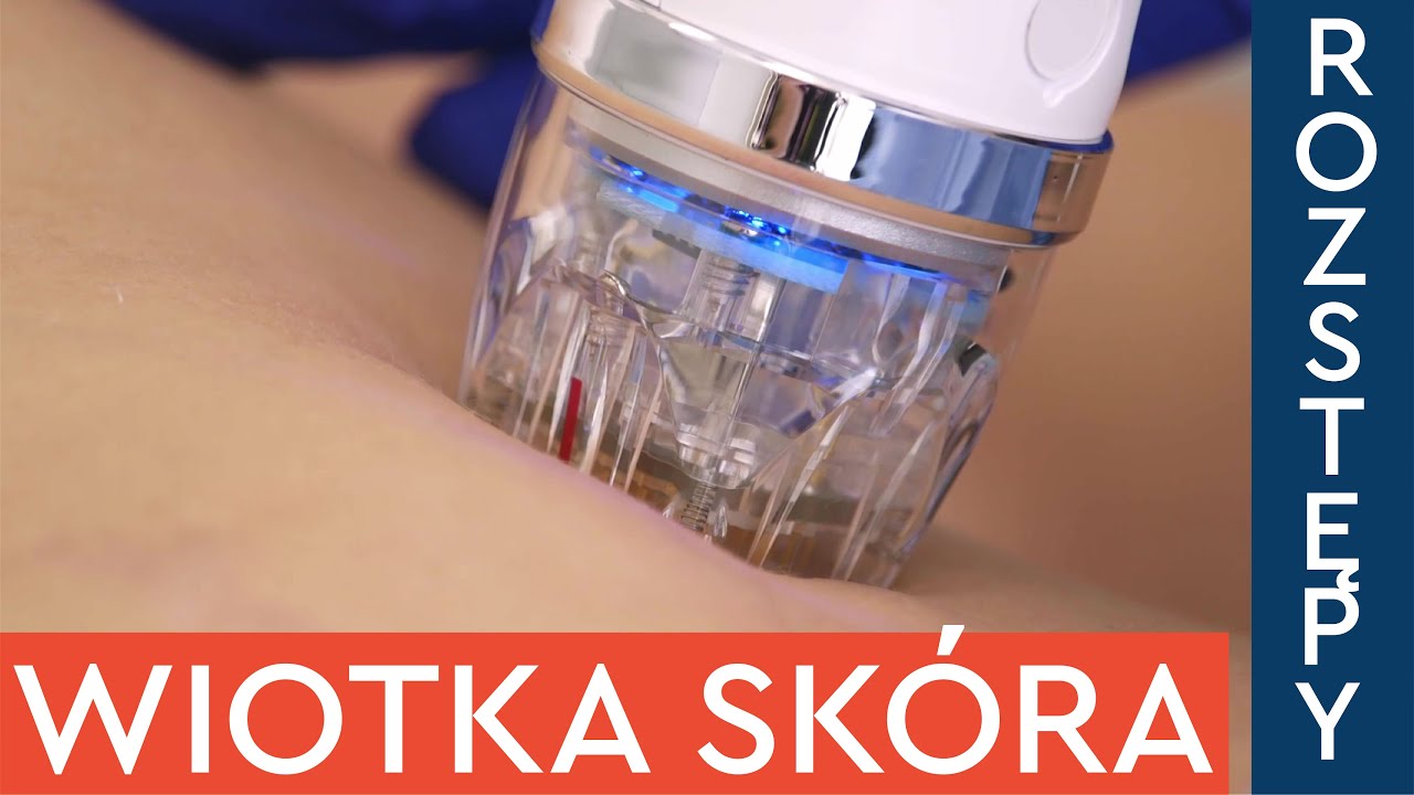 Wiotka skóra i rozstępy na brzuchu po ciąży? Zabieg radiofrekwencja mikroigłowa. Secret DOU.