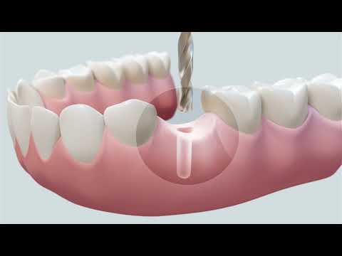 Mit Implantaten Zahn- und Knochensubstanz erhalten - topDentis Cologne