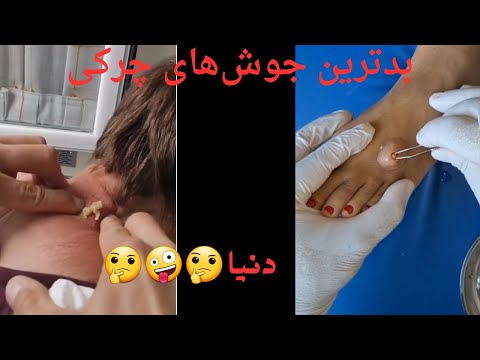 مجموعه بدترین جوش های چرکی دنیا           