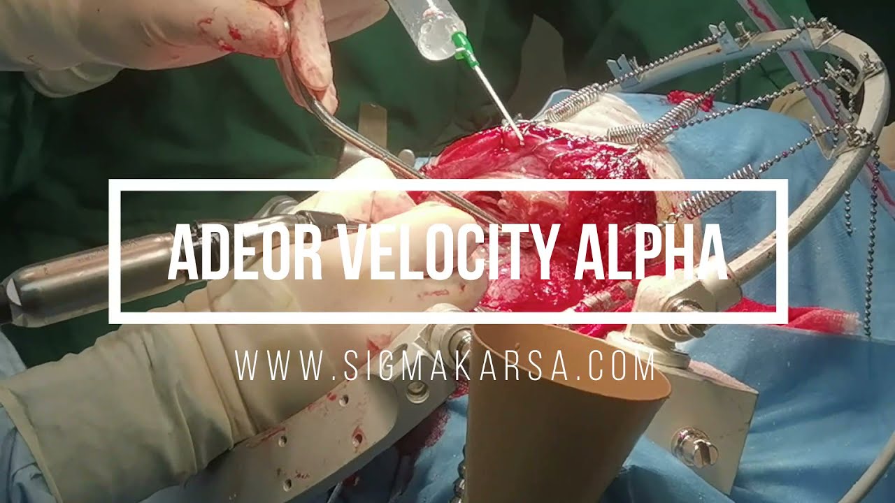 Adeor Velocity Alpha High Speed Drill at Pondok Indah Hospital - Jakarta