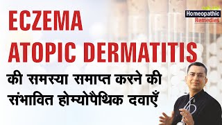 एक्जिमा || Eczema || Atopic Dermatitis || Natural homeopathic remedies with symptoms