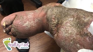 SEVERE ELEPHANTIASIS & LYMPHEDEMA. DO NOT MISS THIS EXTREME CASE OF DIABETIC FOOT CARE!