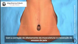 Como Funciona A Abdominoplastia