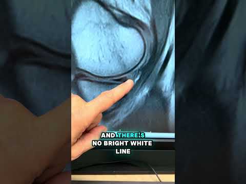 WILL A BRUISED MENISCUS HEAL