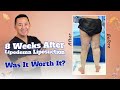 She Saw Her Liposuction Results the Moment She Stood Up! 🎨 Dr. Su’s Artistic Lipedema Transformation