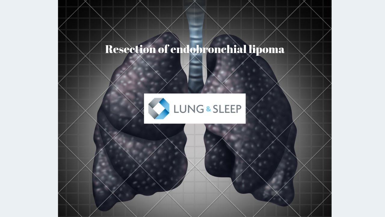 Endobronchial lipoma removed with bronchoscopy, loop diathermy and cryoprobe debridement