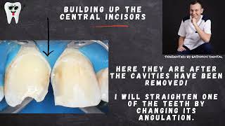 Direct Composite Build-Up of the Central Incisors
