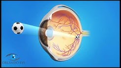 Bästa ögonmakeupborttagare efter kataraktoperation
