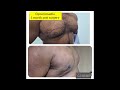 Gynecomastia surgery result after 1 month #Gynecomastia #maleboobs #aestheticanepal #drsanjib