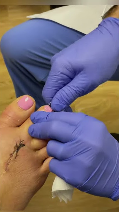 Pulling a k-Wire out of a toe after hammer toe surgery | #shorts