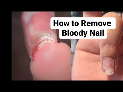 You Injured a Nail: Tips on Best Treatment