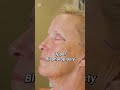 Facial rejuvenation testimony plasticsurgeon beforeandafter transformation antiaging cosmetic