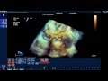 How to assess the Aortic root dimensions by 3D-TEE (Q-lab)