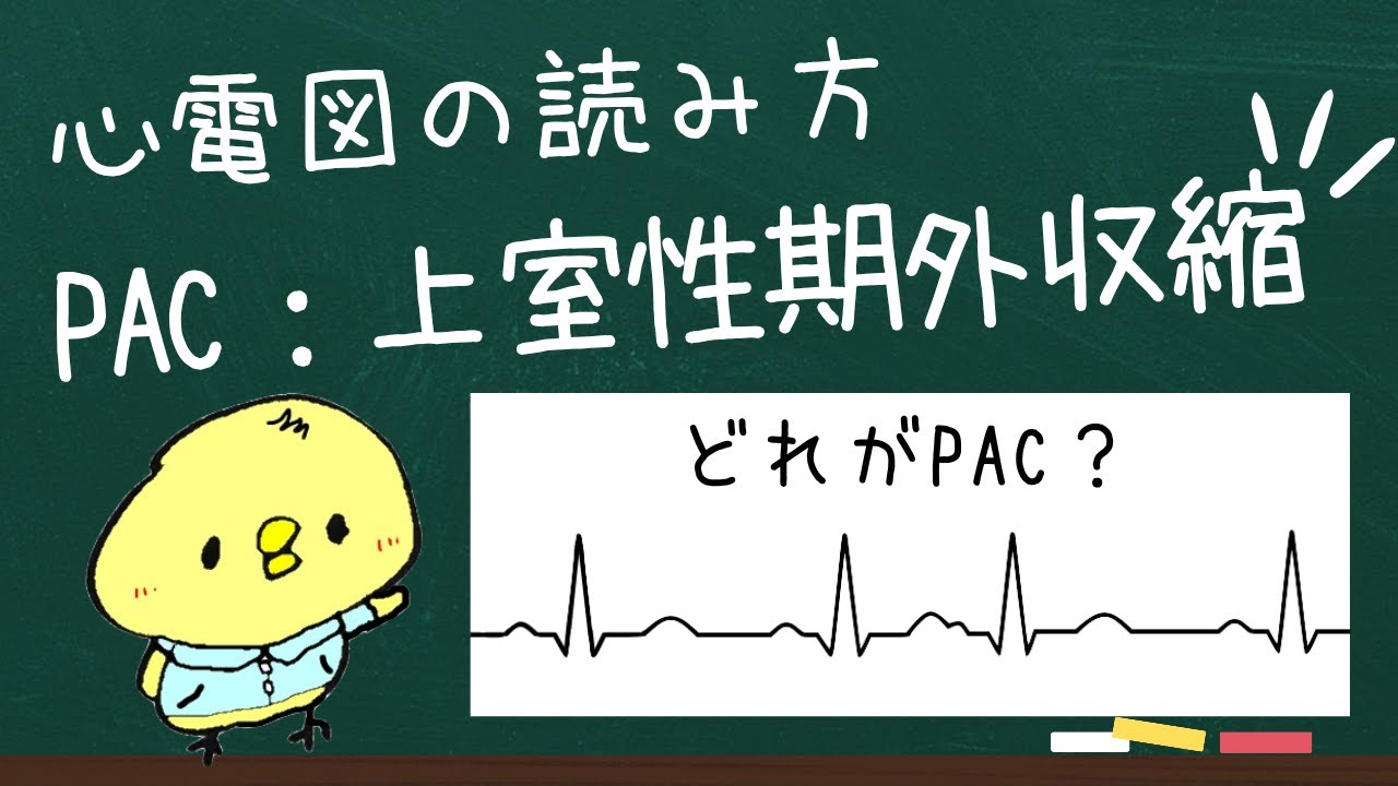 Pac 心電図 対応 | Psvt 心電図 , 心室期外収縮（PVC） – BTIIG