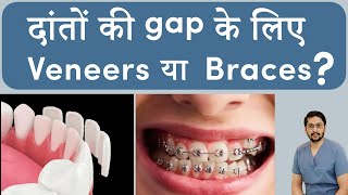 India's Most Popular Teeth Gap Treatment Options (2024) | Dental veneers in India| Braces in Indore by SERAPHIC DENTAL CLINIC INDORE 1,165 views 1 month ago 7 minutes, 48 seconds