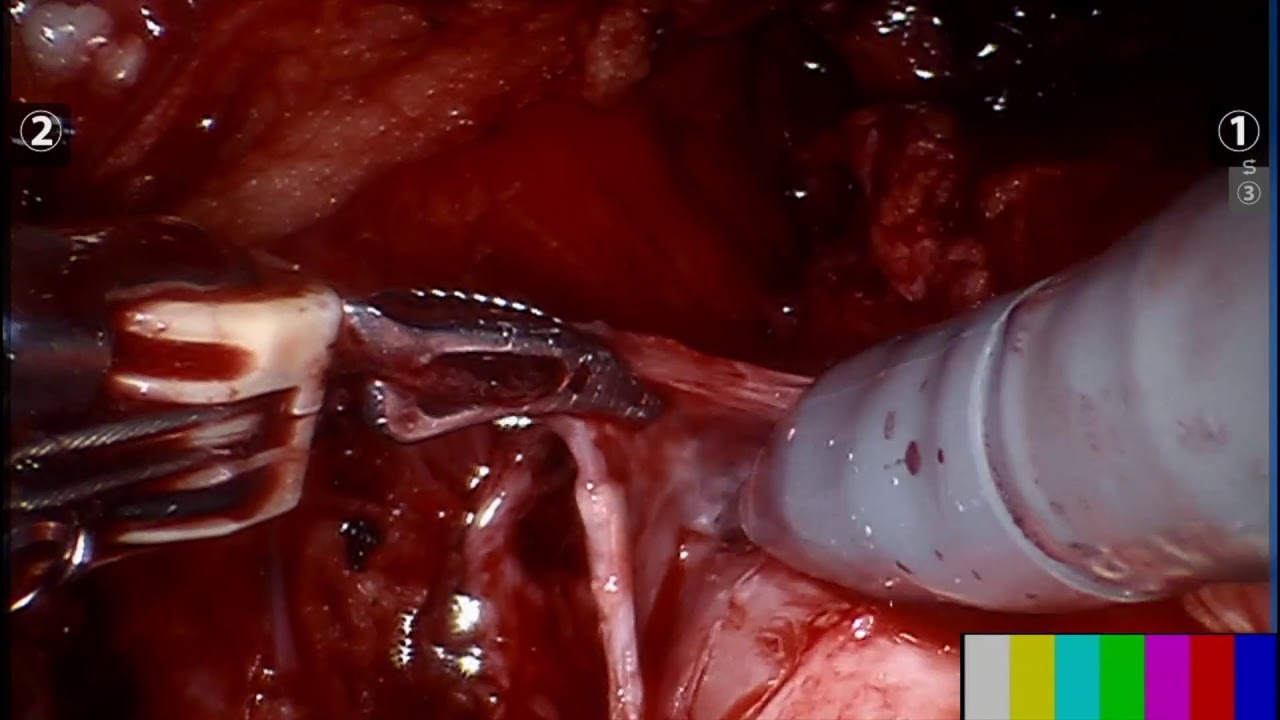 Robotic Radical Prostatectomy left sided erectile nerve spare by Dr Elmes