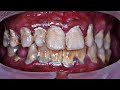 45 yo. Male&#39;s Teeth | Karang Gigi | Scaling | Dentist | Dokter Gigi Tri Putra