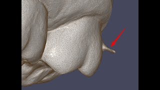 Simplyceph 3DS using of the Lasso tool