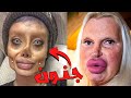 ابشع عمليات التجميل فى العالم - مشاهد غير مناسبة للأطفال +18